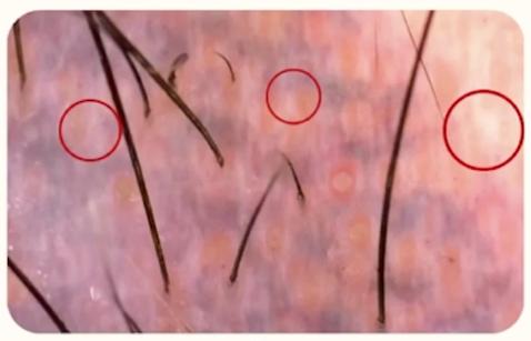 Tricoscopia — alopecias