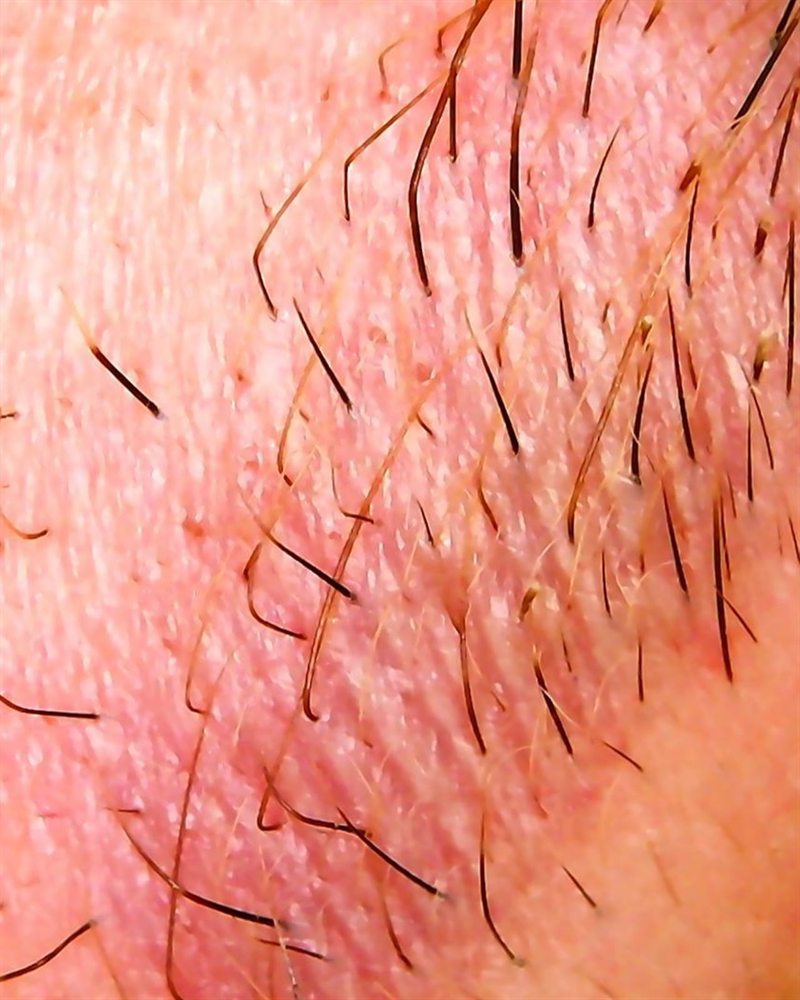 Tricoscopia — alteração na barreira cutânea