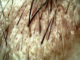 Tricoscopia — fibrose