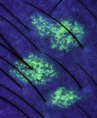 Tricoscopia — infecção de pele